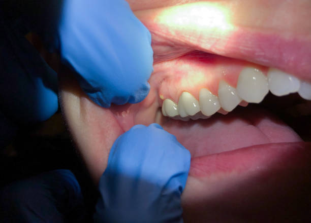 Best Emergency Wisdom Teeth Removal in Villas, FL